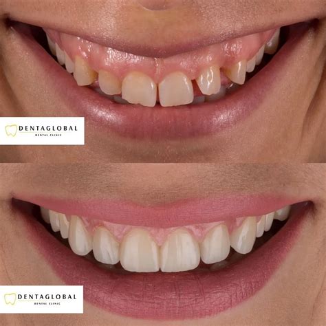 veneers in turkey reddit|Dental Veneers in Turkey .
